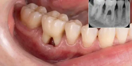 Procedimento: Terapia de doenças periodontais