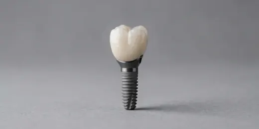 Procedimento: Implantes dentários unitários